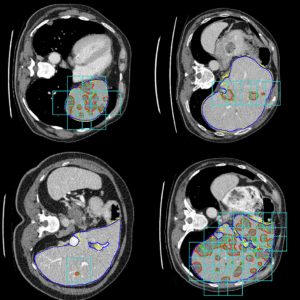 Detection-aided liver lesion segmentation using deep learning